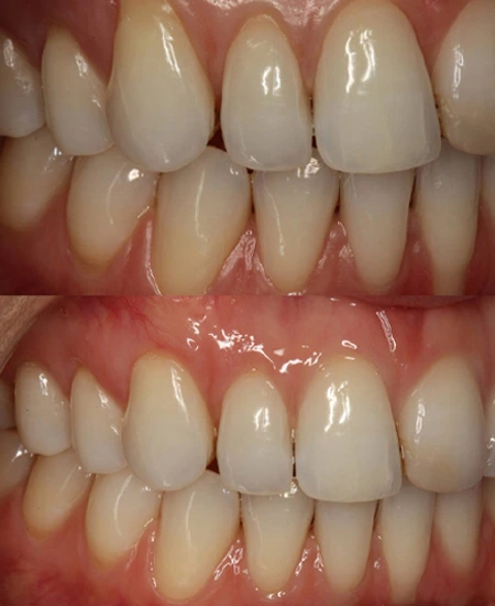 Gingival Recession