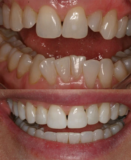Invisalign Before and after
