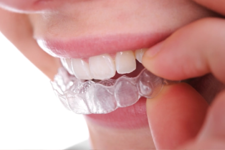 Common Myths about Invisalign