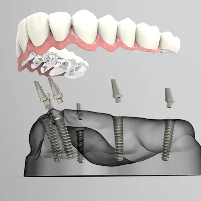 Dental Implants A Solid Choice